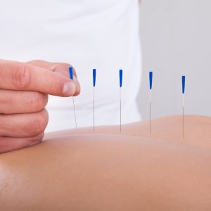 medical-acupuncture-york