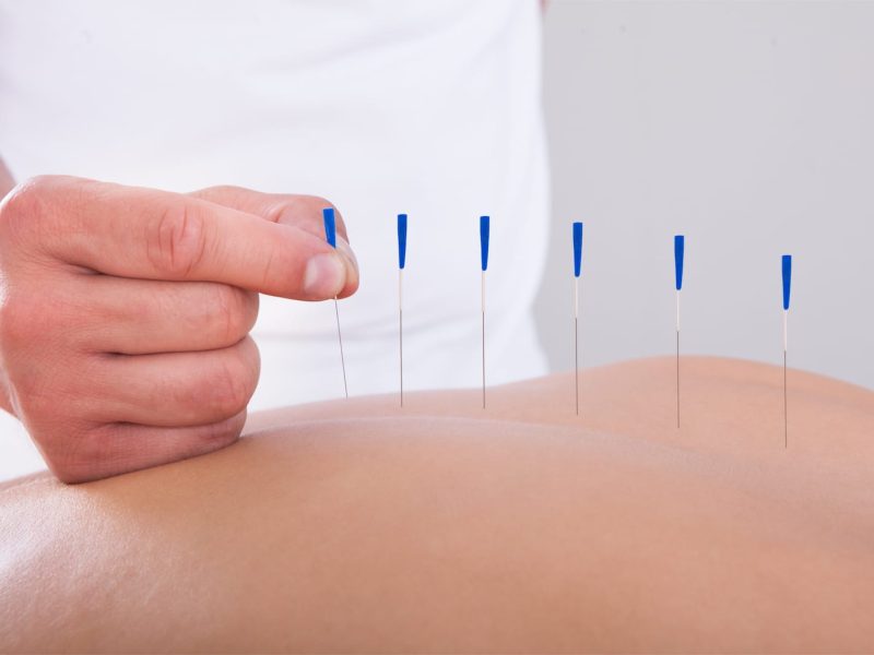 medical-acupuncture-york